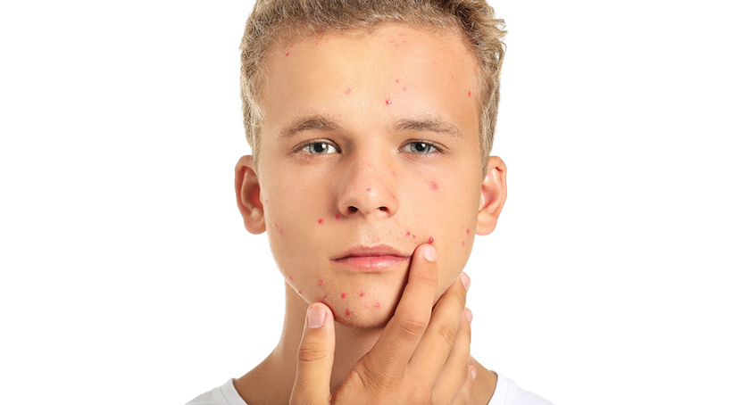 Got Acne? Patch It Up!